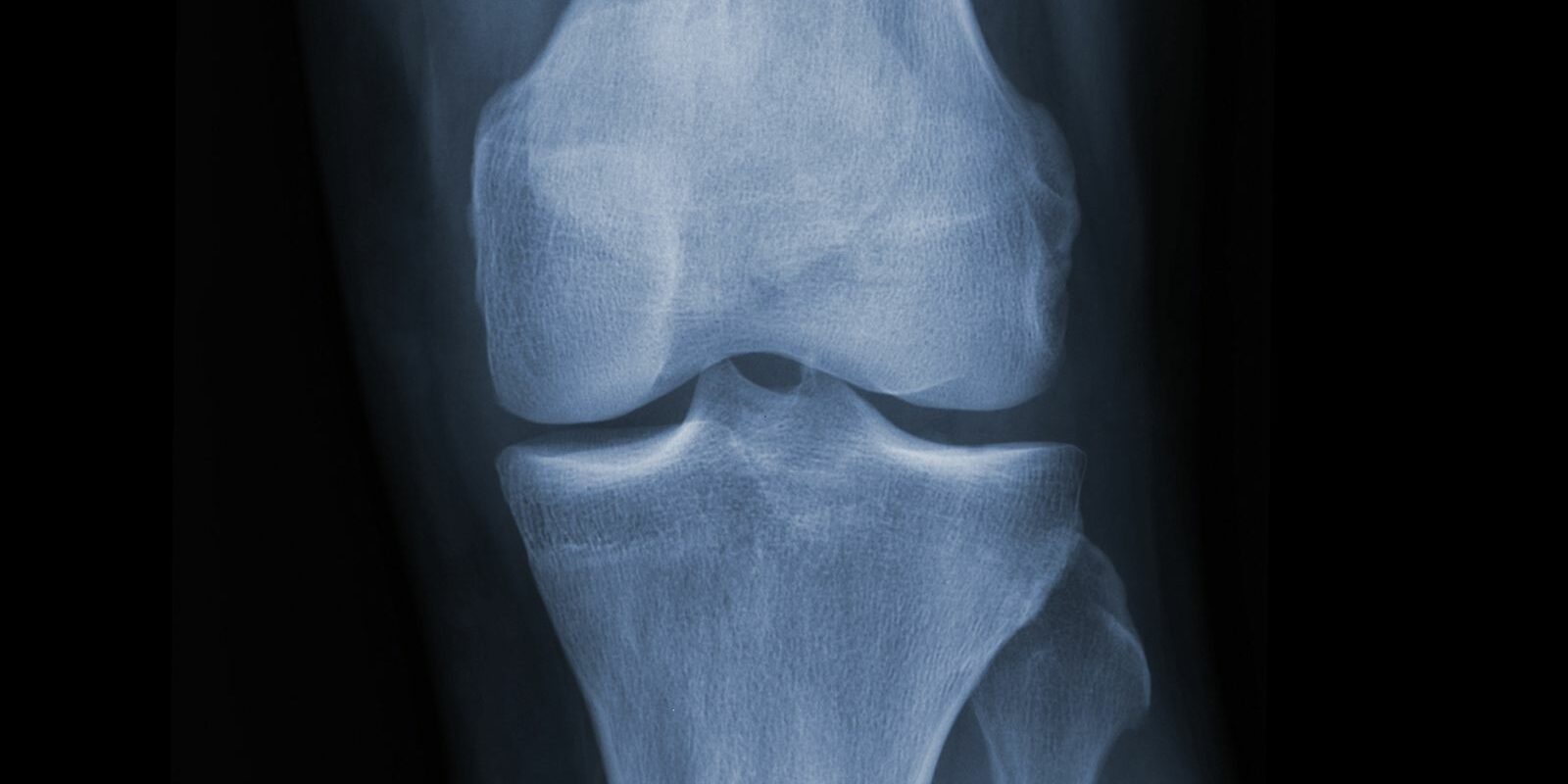 Vitamin D supplementation and bone density FitForMe Research