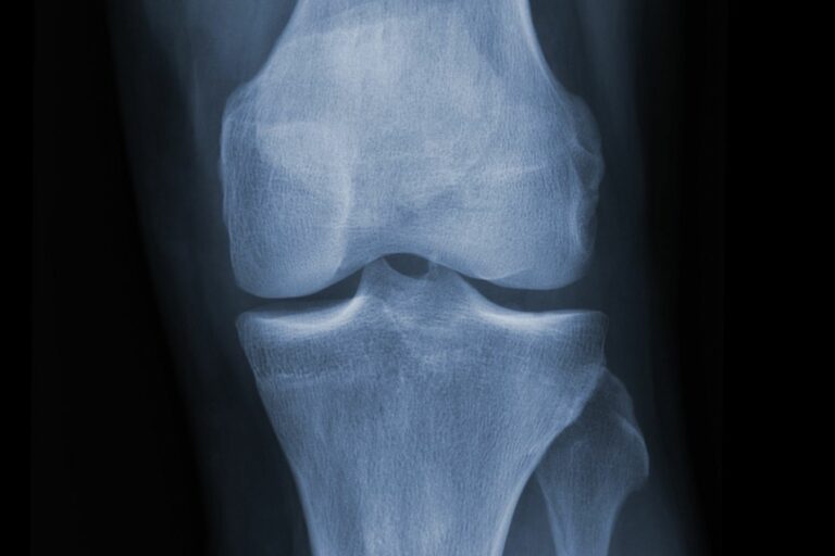 bone density mass scan