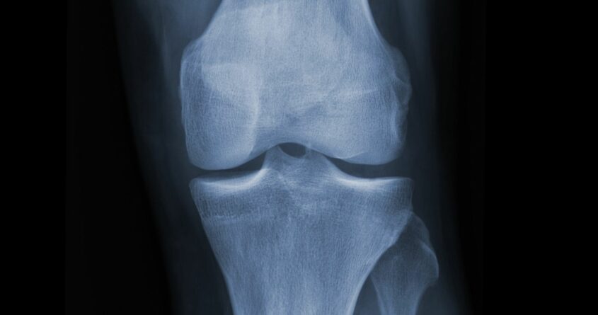 bone density mass scan